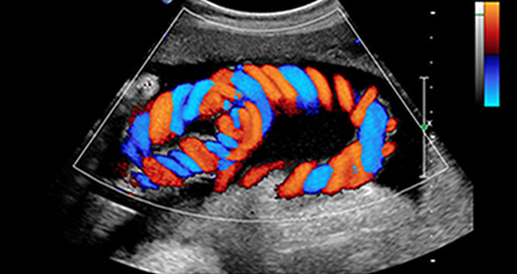 HD Colour Doppler Image